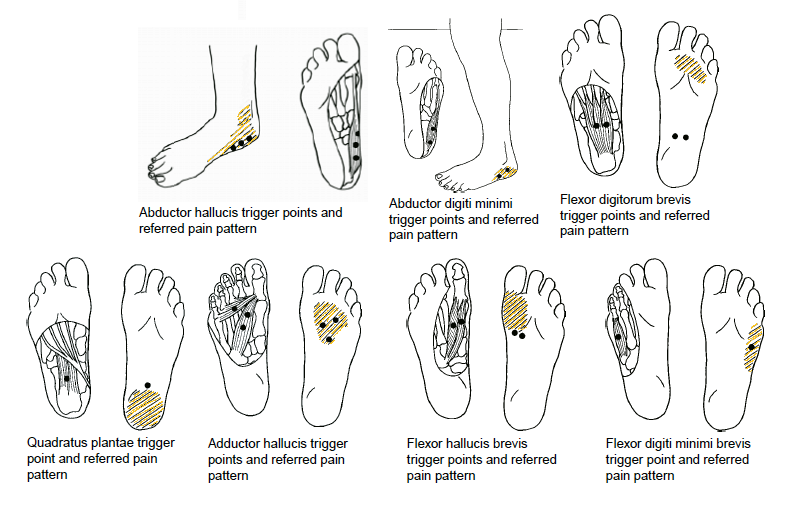 UNCOVERING RELIEF FROM PAIN: MYOFASCIAL TRIGGER POINTS EXPLAINED